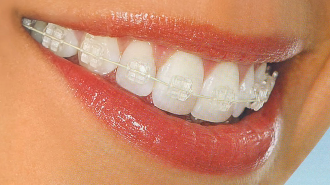 AdelaideDental_Treatments-TeethStraightening_ver1
